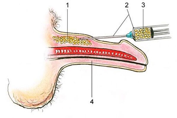 Lipofilling - zavedenie tukového tkaniva do drieku penisu