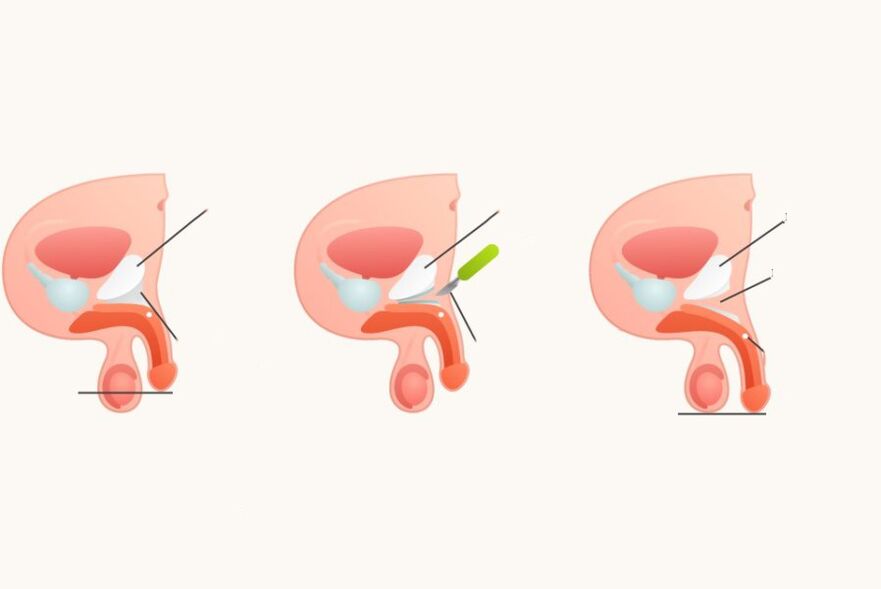Ligamentotómia na zvýšenie penisu