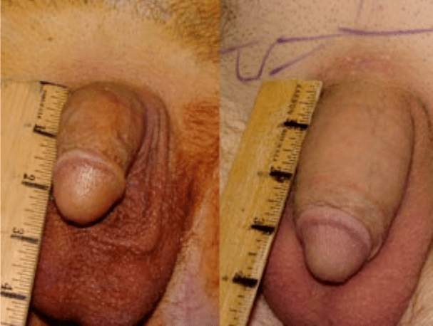 Pred a po lipofillingu a implantácii gélu