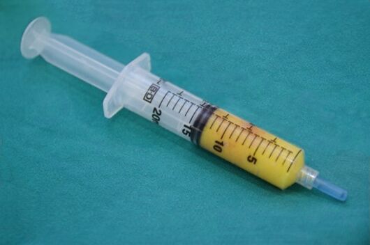 Striekačka s tukovým tkanivom na lipofilling