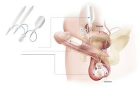 zavedenie implantátov do penisu